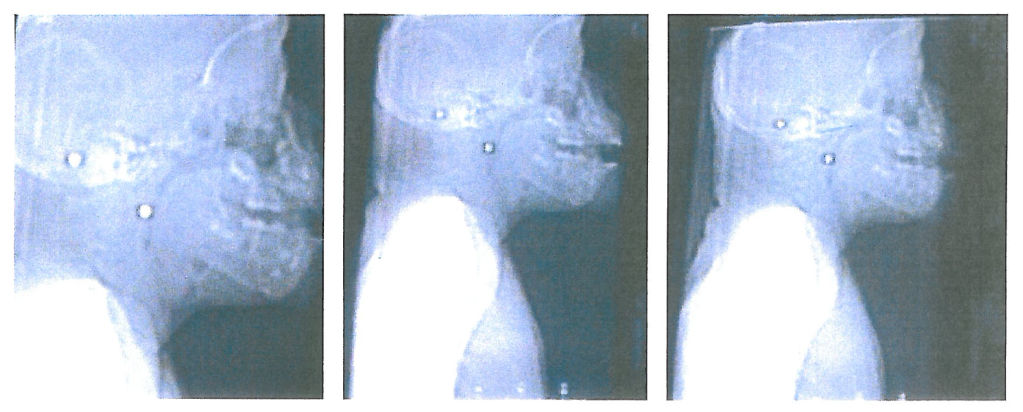 Chimpanzee Chocolat's X-rays showing the bullets that have caused her disablility Picture: G Cotman and Monkey World 2001